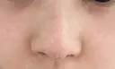 軟骨移植 / 鼻孔縁挙上 / 鼻尖縮小 くさのたろうクリニック DAY 14 サムネイル用
