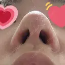 軟骨移植 / 鼻孔縁挙上 / 鼻尖縮小 くさのたろうクリニック DAY 14 サムネイル用