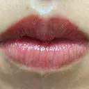 アートメイク（唇） こいずみ形成クリニック名古屋 DAY 1 サムネイル用