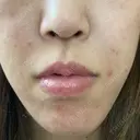 肌ヒアルロン酸注入（たるみ・シワ改善） ヴェリテクリニック 名古屋院 DAY 1 サムネイル用