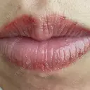 アートメイク（唇） こいずみ形成クリニック名古屋 DAY 2 サムネイル用