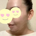 脂肪吸引（顔） / 脂肪注入（肌） / ヒアルロン酸注入（あご） / ボトックス（エラ・小顔） / ダーマペン Mods Clinic（モッズクリニック） 大阪院 DAY 91 サムネイル用