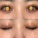 二重埋没 オーキッド美容クリニック東京御徒町 DAY 5 サムネイル用