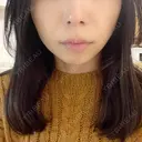 糸リフト / ボトックス（エラ・小顔） / ヒアルロン酸注入（頬） TCB東京中央美容外科 銀座有楽町院 AFTER サムネイル用