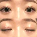 二重埋没 水の森美容クリニック 大阪梅田院 DAY 312 サムネイル用