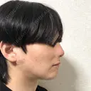 脂肪吸引（顔） 石倉クリニック 水戸院 DAY 10 サムネイル用