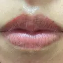 アートメイク（唇） こいずみ形成クリニック名古屋 DAY 3 サムネイル用