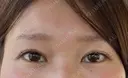 二重切開 / 目元修正 こまちクリニック DAY 150 サムネイル用