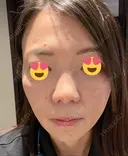 ボトックス（エラ・小顔） TCB東京中央美容外科 京都駅前院 DAY 95 サムネイル用