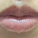アートメイク（唇） こいずみ形成クリニック名古屋 DAY 4 サムネイル用