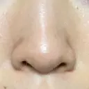 毛穴洗浄（ハイドラフェイシャルなど） / ニードルRF（ポテンツァなど） Zetith Beauty Clinic 銀座院 DAY 10 サムネイル用