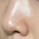 毛穴洗浄（ハイドラフェイシャルなど） / ニードルRF（ポテンツァなど） Zetith Beauty Clinic 銀座院 DAY 10 サムネイル用