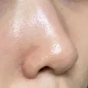 毛穴洗浄（ハイドラフェイシャルなど） / ニードルRF（ポテンツァなど） Zetith Beauty Clinic 銀座院 DAY 10 サムネイル用