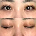 二重埋没 オーキッド美容クリニック東京御徒町 DAY 6 サムネイル用