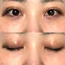 二重埋没 オーキッド美容クリニック東京御徒町 DAY 7 サムネイル用