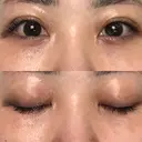 二重埋没 オーキッド美容クリニック東京御徒町 DAY 8 サムネイル用