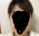 ボトックス（エラ・小顔） 湘南美容クリニック 名古屋栄院 DAY 8 サムネイル用