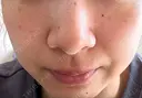 毛穴洗浄（ハイドラフェイシャルなど） / 光治療（フォトフェイシャルなど） 代官山ウィメンズクリニック AFTER サムネイル用
