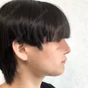 脂肪吸引（顔） 石倉クリニック 水戸院 DAY 14 サムネイル用