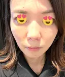 ボトックス（エラ・小顔） TCB東京中央美容外科 京都駅前院 DAY 98 サムネイル用