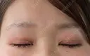 二重切開 / 目元修正 こまちクリニック DAY 154 サムネイル用