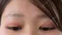 二重切開 / 目元修正 こまちクリニック DAY 154 サムネイル用