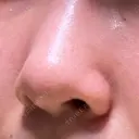 毛穴洗浄（ハイドラフェイシャルなど） / ニードルRF（ポテンツァなど） Zetith Beauty Clinic 銀座院 DAY 15 サムネイル用