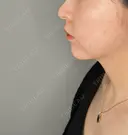 ボトックス（あご） / ヒアルロン酸注入（あご） ASTRA BEAUTY CLINIC DAY 0 サムネイル用