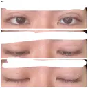 二重埋没 湘南美容クリニック 仙台院 DAY 3 サムネイル用