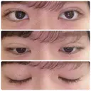 二重埋没 湘南美容クリニック 仙台院 DAY 5 サムネイル用