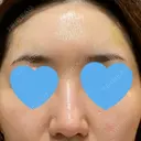 ヒアルロン酸注入（額） / ヒアルロン酸注入（こめかみ） LA CLEF CLINIC（ラクレクリニック） DAY 3 サムネイル用