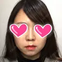 隆鼻術 / 鼻尖形成（切開） / 鼻中隔延長（切開） / 小鼻縮小（切開） ザ・プラス美容外科 DAY 100 サムネイル用