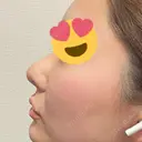 その他（鼻） / 軟骨移植 / 鼻尖形成（非切開） WOM CLINIC GINZA （ワム クリニック ギンザ） DAY 5 サムネイル用