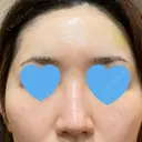 ヒアルロン酸注入（額） / ヒアルロン酸注入（こめかみ） LA CLEF CLINIC（ラクレクリニック） DAY 4 サムネイル用