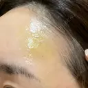 ヒアルロン酸注入（額） / ヒアルロン酸注入（こめかみ） LA CLEF CLINIC（ラクレクリニック） DAY 4 サムネイル用