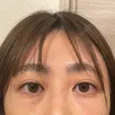 クマ治療 / 脂肪注入（目の下） / その他（目元） セオリークリニック DAY 28 サムネイル用