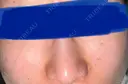 ピーリング（ハリ・ツヤ） まゆりなclinic 名古屋栄 DAY 11 サムネイル用