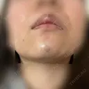 ボトックス（あご） / ヒアルロン酸注入（あご） / ボトックス（口角） / ボトックス（人中） / その他（口元） 表参道スキンクリニック 名古屋院（DAILY SKIN CLINIC提携院） DAY 2 サムネイル用