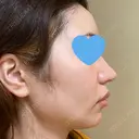ヒアルロン酸注入（額） / ヒアルロン酸注入（こめかみ） LA CLEF CLINIC（ラクレクリニック） DAY 7 サムネイル用