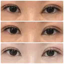 二重埋没 / 目頭切開 くさのたろうクリニック DAY 7 サムネイル用