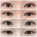 二重埋没 / 目頭切開 くさのたろうクリニック DAY 41 サムネイル用