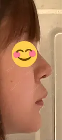 ヒアルロン酸注入（あご） 東京エビスクリニック DAY 1 サムネイル用