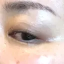 PRP皮膚再生療法 / その他（目元） ももスキンケアクリニック DAY 7 サムネイル用