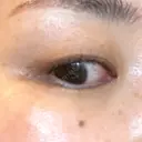 PRP皮膚再生療法 / その他（目元） ももスキンケアクリニック DAY 7 サムネイル用