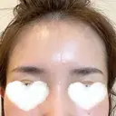 PRP皮膚再生療法 ももスキンケアクリニック DAY 7 サムネイル用