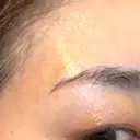 PRP皮膚再生療法 ももスキンケアクリニック DAY 7 サムネイル用