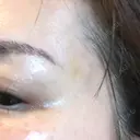 PRP皮膚再生療法 ももスキンケアクリニック DAY 7 サムネイル用