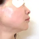 ハイフ（顔） 湘南美容クリニック 岡山院 DAY 7 サムネイル用