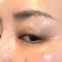 PRP皮膚再生療法 / その他（目元） ももスキンケアクリニック DAY 8 サムネイル用