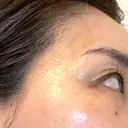 PRP皮膚再生療法 ももスキンケアクリニック DAY 8 サムネイル用